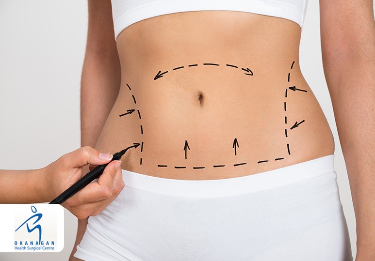 4 Factors To Consider Before Liposuction