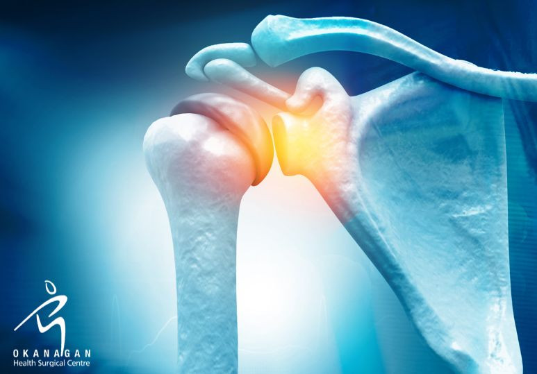 Post-Shoulder Surgery 101: At-Home Recovery Tips, Orthopedic Blog