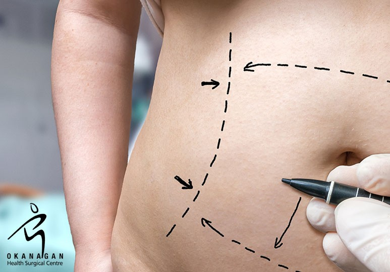 Are You a Suitable Candidate For an Abdominoplasty?