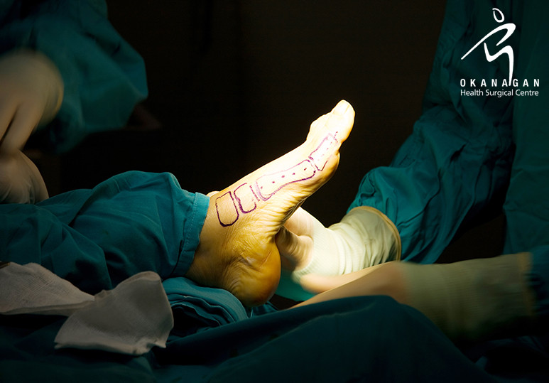 okanagan-health-surgical-blog- foot operations surgery