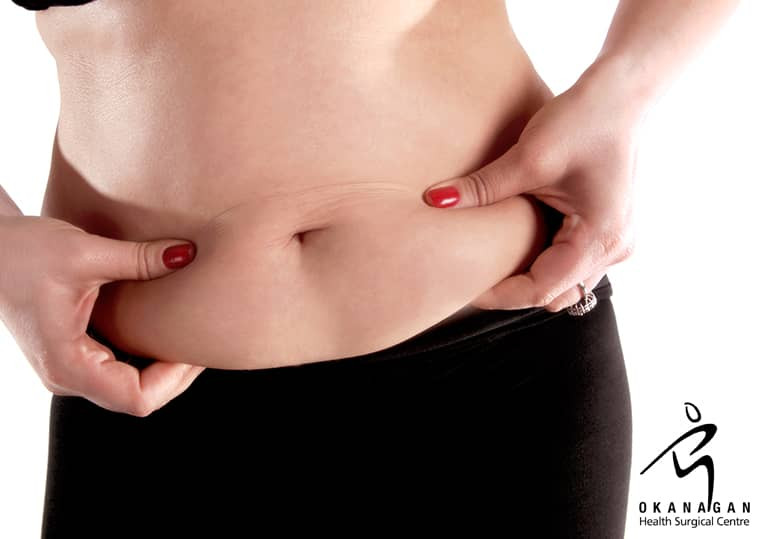 Okanagan Health Surgical - Tummy Tucks: What To Consider From Consultation To Recovery