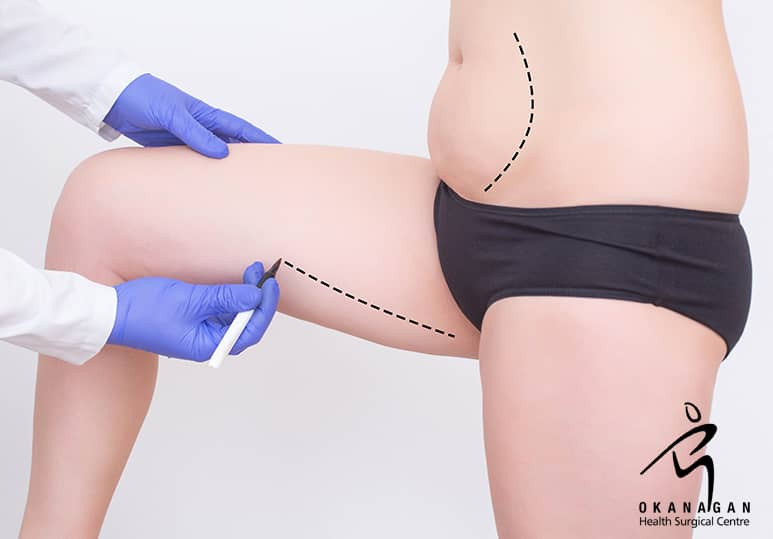 Okanagan Health Surgical - How To Choose Between A Tummy Tuck And Liposuction