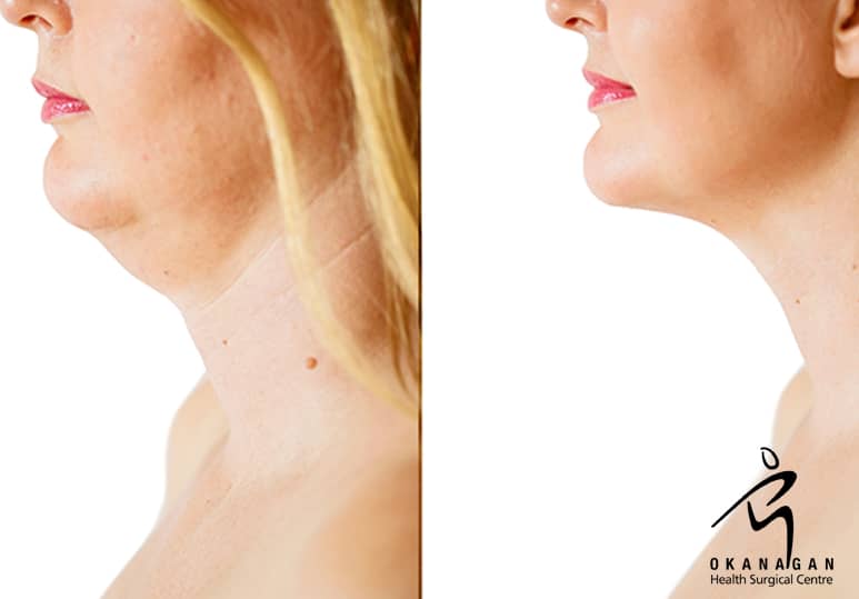 Everything You Need To Know About Chin Surgery 