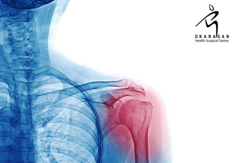 What Conditions Are Treated With Shoulder Surgery?