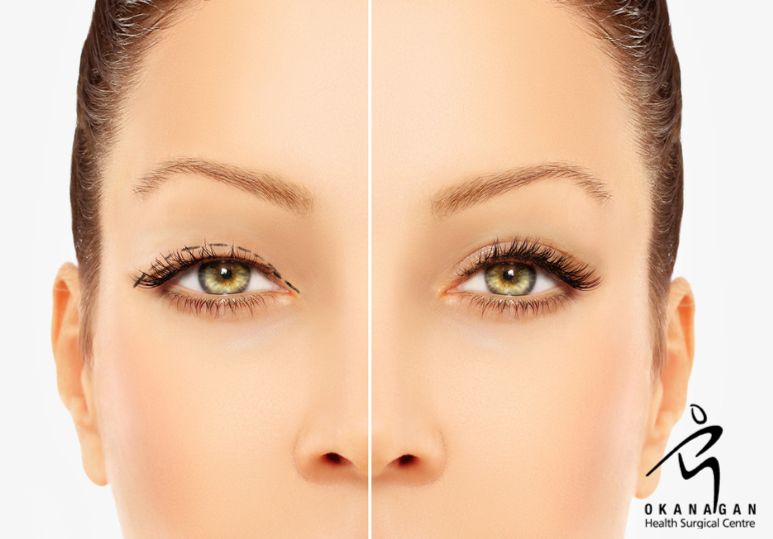 Blepharoplasty: Plastic Surgery That Opens Your Eyes